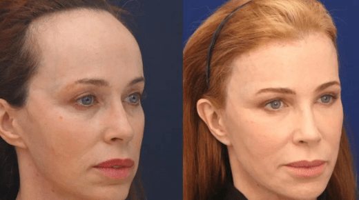 Forehead Reduction Surgery – Before and After