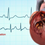 Understanding Atrial Fibrillation Stroke Prognosis - What to Expect After Diagnosis