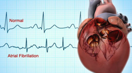 Understanding Atrial Fibrillation Stroke Prognosis - What to Expect After Diagnosis