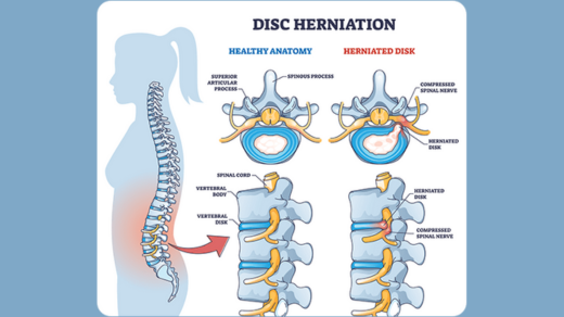 Top Lifestyle Changes Needed to Reduce Back Pain